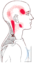 Trigger Point Upper Trapezius